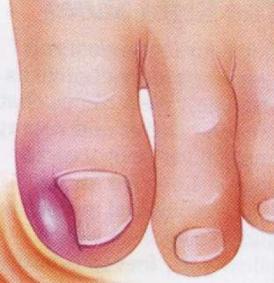 Вросший ноготь - одно из самых болезненных заболеваний ногтей