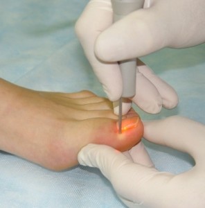 Лазерная коррекция вросшего ногтя - один из самых безболезненных методов его лечения